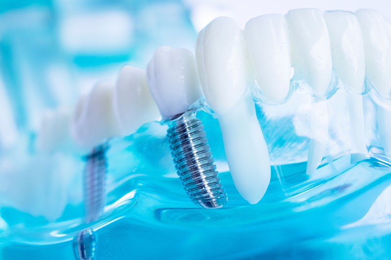 Value Dental Center | Dental Cleanings, Dental Bridges and Periodontal Treatment